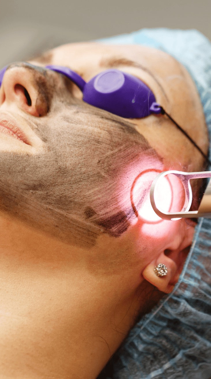 Carbon Laser Facial