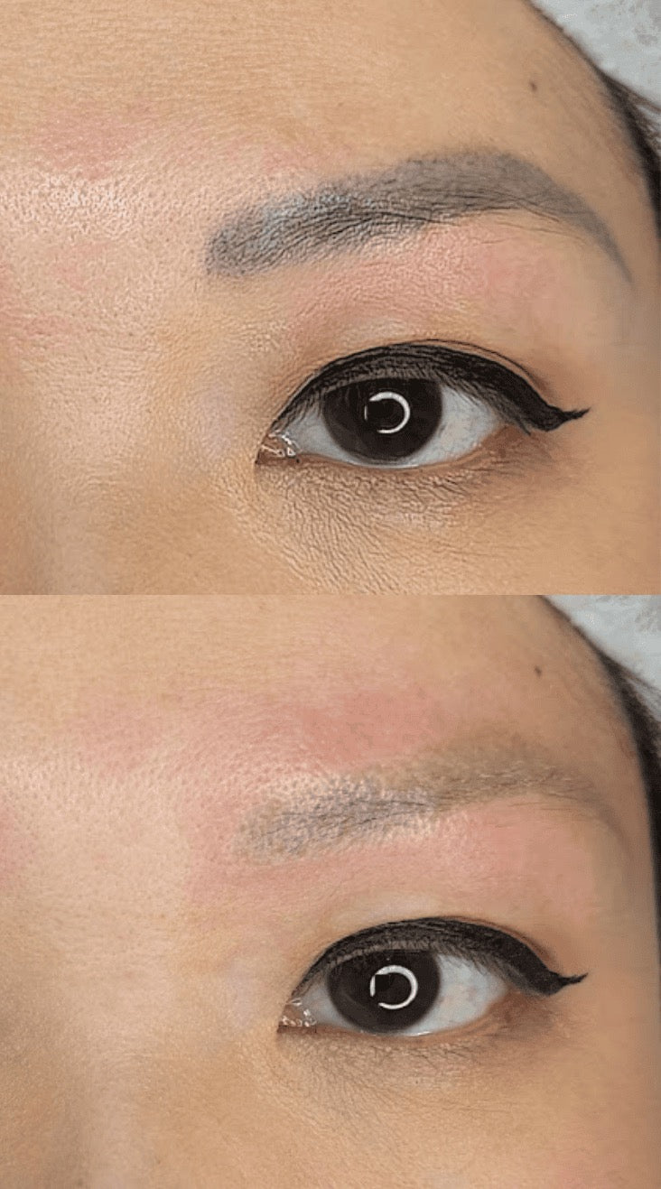 Eyebrow Tattoo Removal