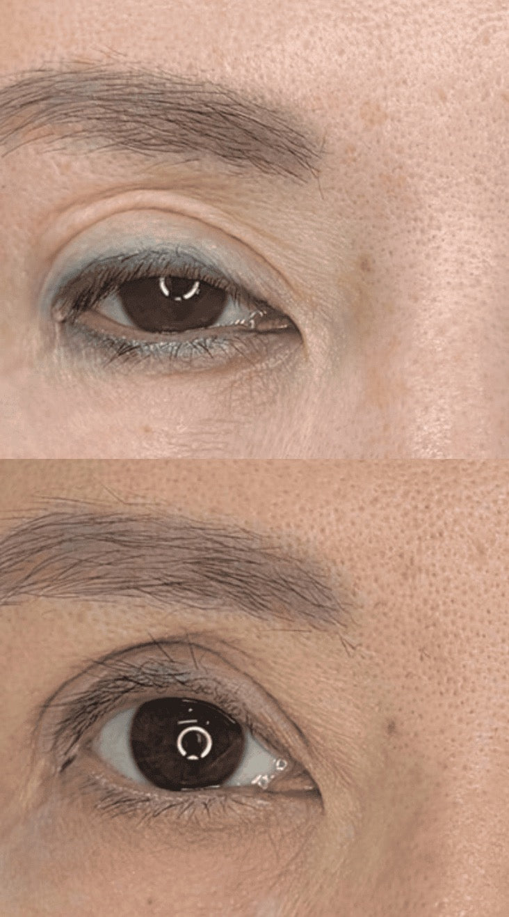 Eyeliner Tattoo Removal